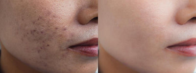 Struggling with Dark Spots on Skin? Here’s the Proven Solution to Eliminate Them Fast