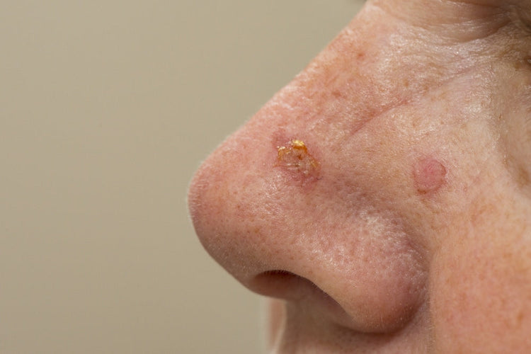 Actinic Keratosis: Causes, Symptoms, and Skincare Solutions for Prevention