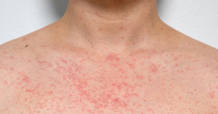 Hear Rash on Skin