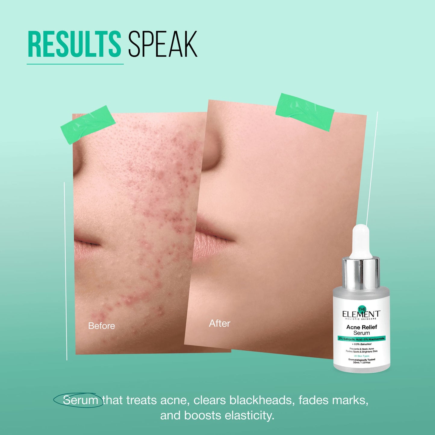 Clear and Bright Skin Combo - Acne Marks & Blemishes Removal Serum + Brightening Sunscreen