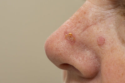 Actinic Keratosis: Causes, Symptoms, and Skincare Solutions for Prevention