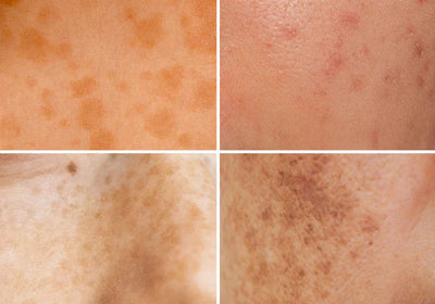 Hyperpigmentation: Causes, Treatments, and Remedies for a Clearer Complexion