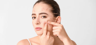 Pimples on Different Areas of the Face: Causes, Meanings, and Treatments