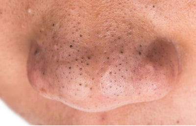 Understanding and Treating Blackheads on Your Nose