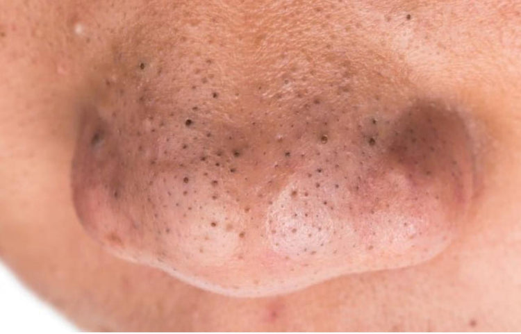 Understanding and Treating Blackheads on Your Nose