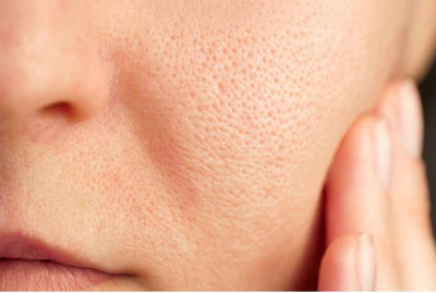 Pores on Face: Causes, Treatments and the Power of Salicylic Acid + Niacinamide