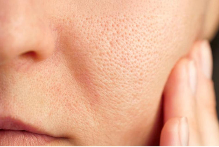 Pores on Face: Causes, Treatments and the Power of Salicylic Acid + Niacinamide