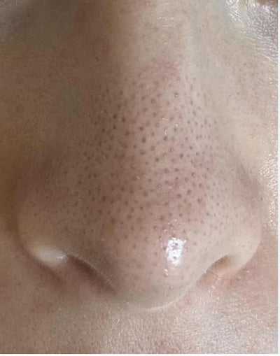Pores on Nose: The Ultimate Guide to Treating, Reducing, and Minimizing Open, Clogged, and Large Pores