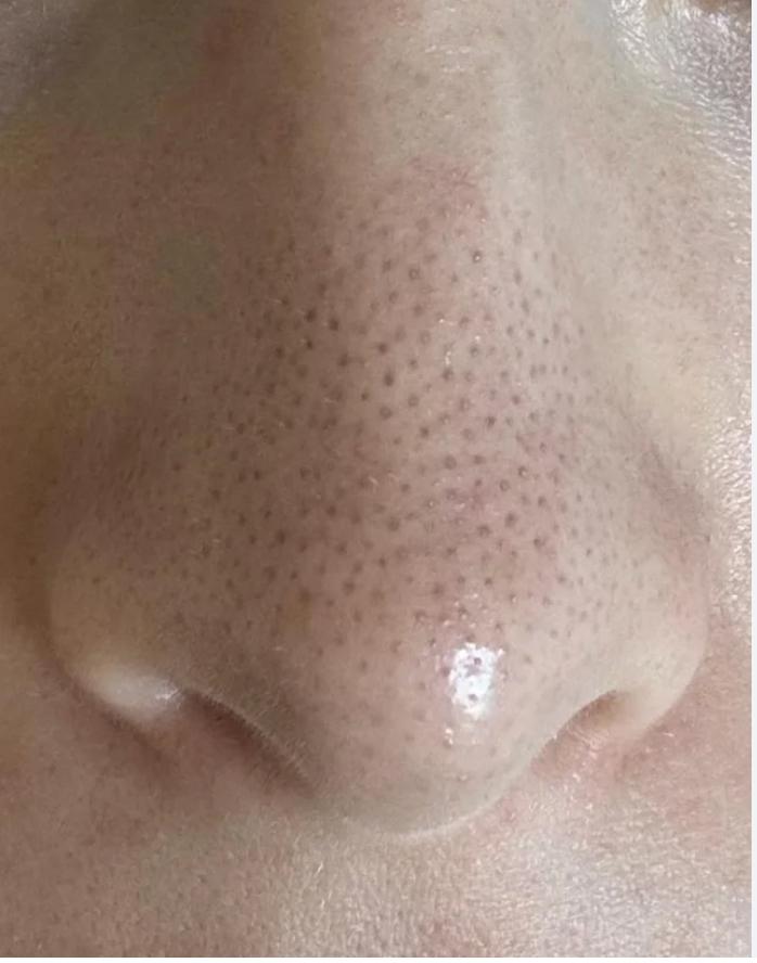 Pores on Nose: The Ultimate Guide to Treating, Reducing, and Minimizing Open, Clogged, and Large Pores