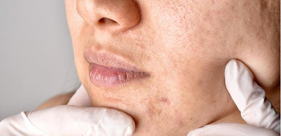 Congested Pores