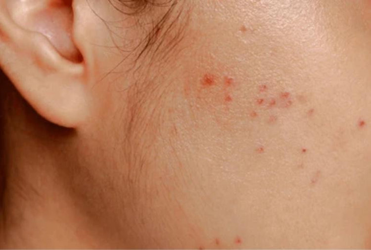 Red Spots and Red Blemishes on Face: Causes, Treatments, and Home Remedies