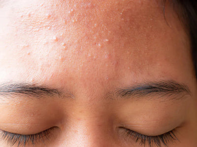 Small Bumps on Face: Causes, Treatments, and Prevention