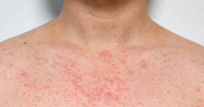 Hear Rash on Skin