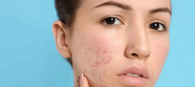Blemishes on Skin: Causes, Treatments, and Skincare Solutions