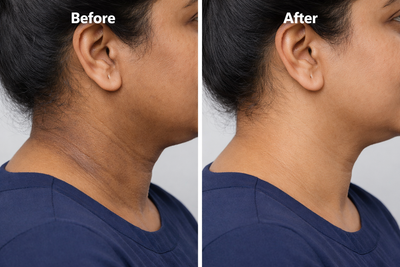 Dark Neck & Body Pigmentation: Causes and How to Even It Out