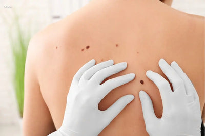 Understanding Melanoma: The Skin Cancer You Need to Know About