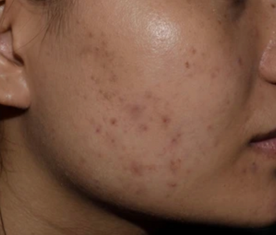 Tired of Black Spots Ruining Your Oily Skin? Discover the Serum That Fades Them Fast (Backed by Science!)