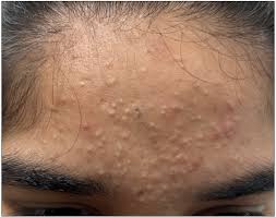 Comedones: Causes, Treatments, and Prevention