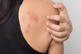 Understanding Skin Rash: Causes, Symptoms, and Skincare Solutions