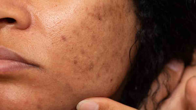The Ultimate Guide to Dark Spots: Causes, Treatments, and Remedies