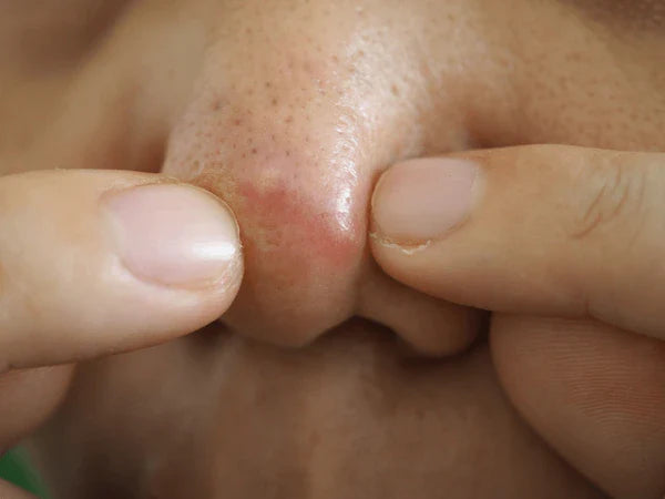Pimple on Nose: Causes, Symptoms, and Effective Treatments
