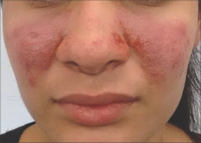 Rosacea: Understanding the Skin Condition and Skincare Ingredients to Avoid and Embrace