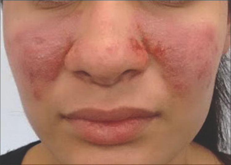 Rosacea: Understanding the Skin Condition and Skincare Ingredients to Avoid and Embrace