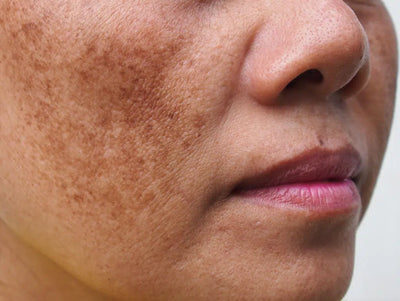 Understanding Skin Pigmentation: Causes, Treatments, and Remedies for a Radiant Complexion