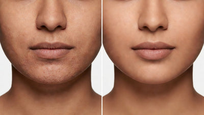 Indian skin editorial showing skin purging versus breakout comparison