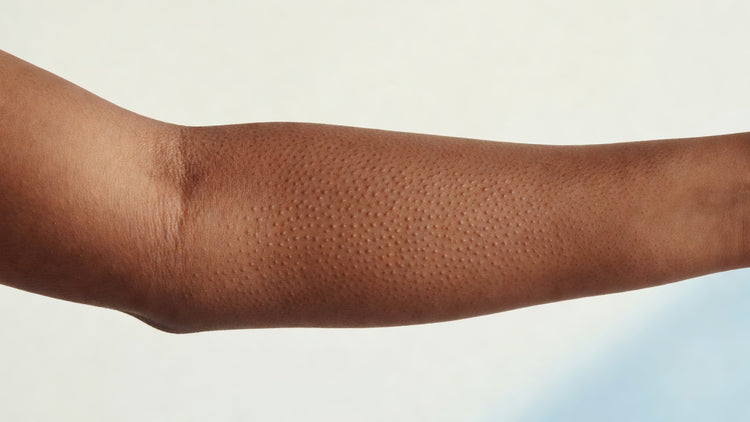 Rough keratosis pilaris bumps on an upper arm, warm brown Indian skin