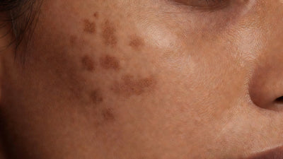 Macro of Indian skin showing flat post-acne marks beside slightly indented scar texture