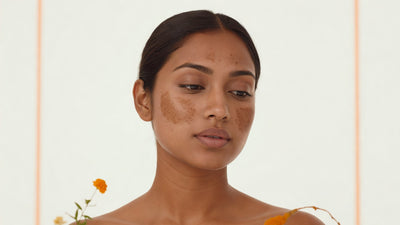 Young Indian woman with warm brown skin showing symmetrical melasma patches on her cheeks