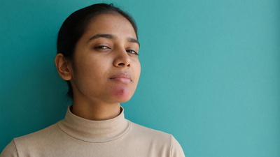 Indian woman with warm brown skin and a single inflamed pimple on her chin, against a teal wall, considering spot treatment options