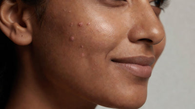 Beautiful Indian woman's cheek showing fading pink-brown post-acne marks becoming lighter
