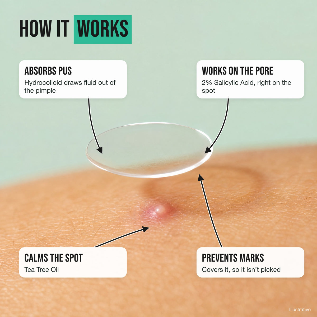 How the pimple patch works: absorbs pus, works on the pore, calms the spot and prevents marks