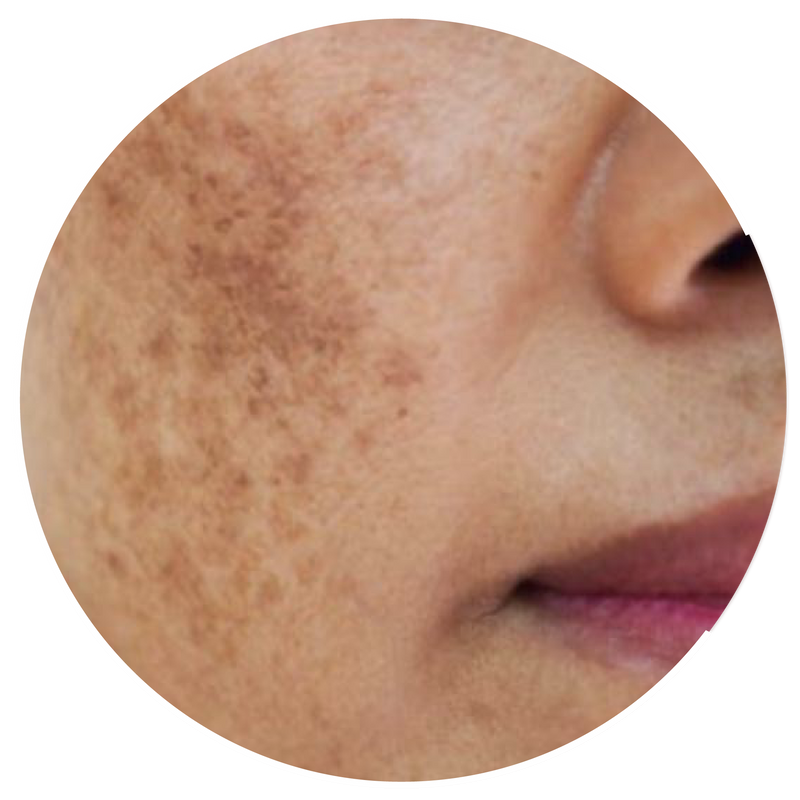 Pigmentation