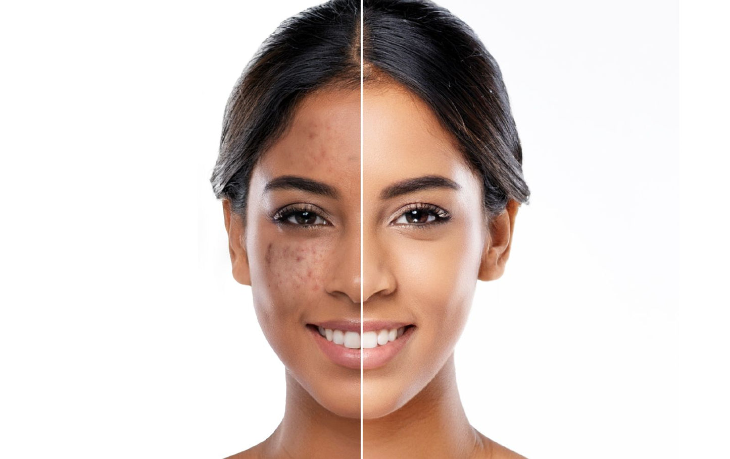 Complete Routine for Clear Skin - Inside Out - Nourish from Inside, Cleanse, Treat, Moisturise, Protect (Copy)