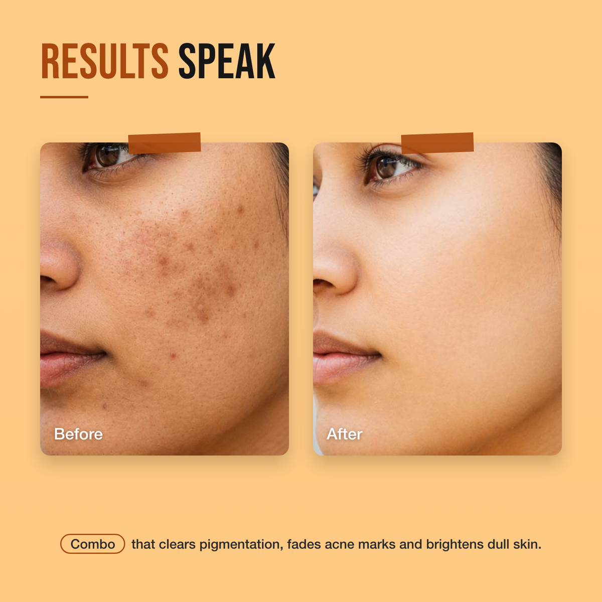 Ultimate Brightening Combo before and after — pigmentation and dark marks visibly lighter